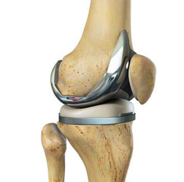 Total Knee Replacement